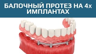 Съемный протез на имлантах. Балочный съемный протез на 4х имплантах