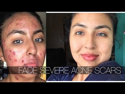 ONE PRODUCT TO FADE SEVERE CYSTIC ACNE SCARS