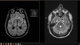 54 year old with left ear infections