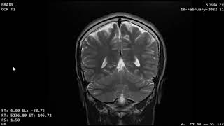 CASE 1134 MRI BRAIN FRONTAL MENINGIOMA