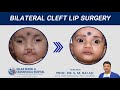 Bilateral Cleft Lip Surgery - Dr SM Balaji, Oral and Maxilloacial Surgeon