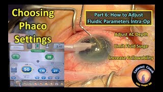 Phaco Fundamentals Part 6: Adjusting Fluidic Parameters during Cataract Surgery