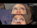 Cat whisker  nostril slimming with pdo threads by dr tsay ageless md