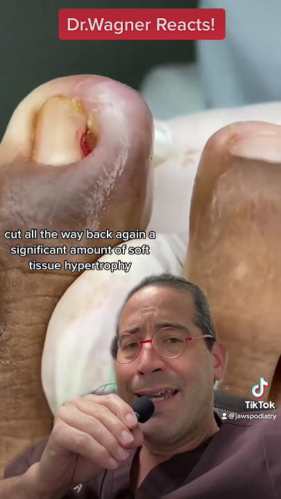 EXTRACTION OF MONSTER INGROWN TOENAIL💪🏼#shorts #ingrown_toenail