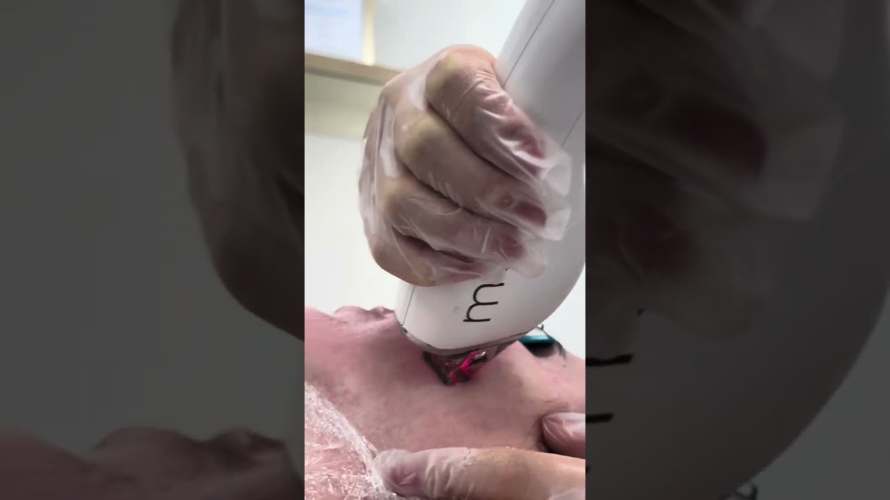 Sciton Moxi Treatment at SK Clinic 