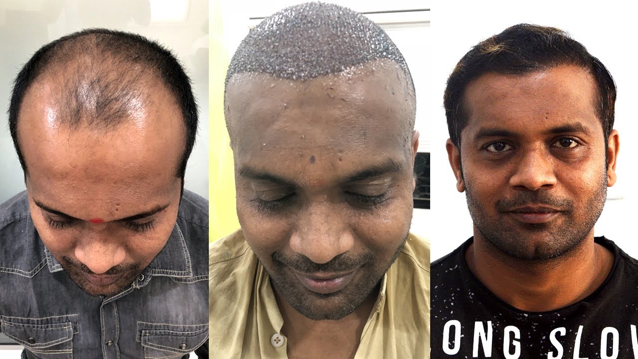 New Roots Hair Transplant Center  Best Hair Transplant clinic at Nagpur  you all will get back your confidence with New Roots Hair Clinic and  Advance Hair Transplant Center  For more