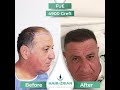 Hair transplant turkey hair of zrian fue 500 graft