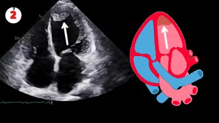2D Echocardiography Cases: 7 Must-Know Cardiac Conditions for Students & Clinicians