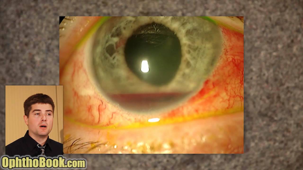 Exploding Eye Lecture YouTube verify-can-a-full-gas-tank-in-your-car-explode-with-the-heat