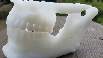 Tutorial: How to Create 3D Printable Dental and Orthodontic Models from Medical CT Scans