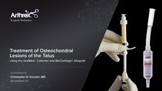 Treatment of Osteochondral Lesions of the Talus Using the GraftNet™ Collector and BioCartilage® Allo