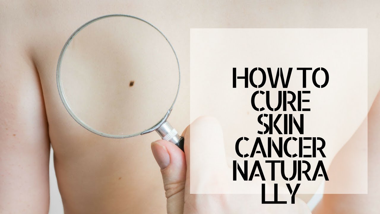 HOW TO CURE SKIN CANCER NATURALLY YouTube