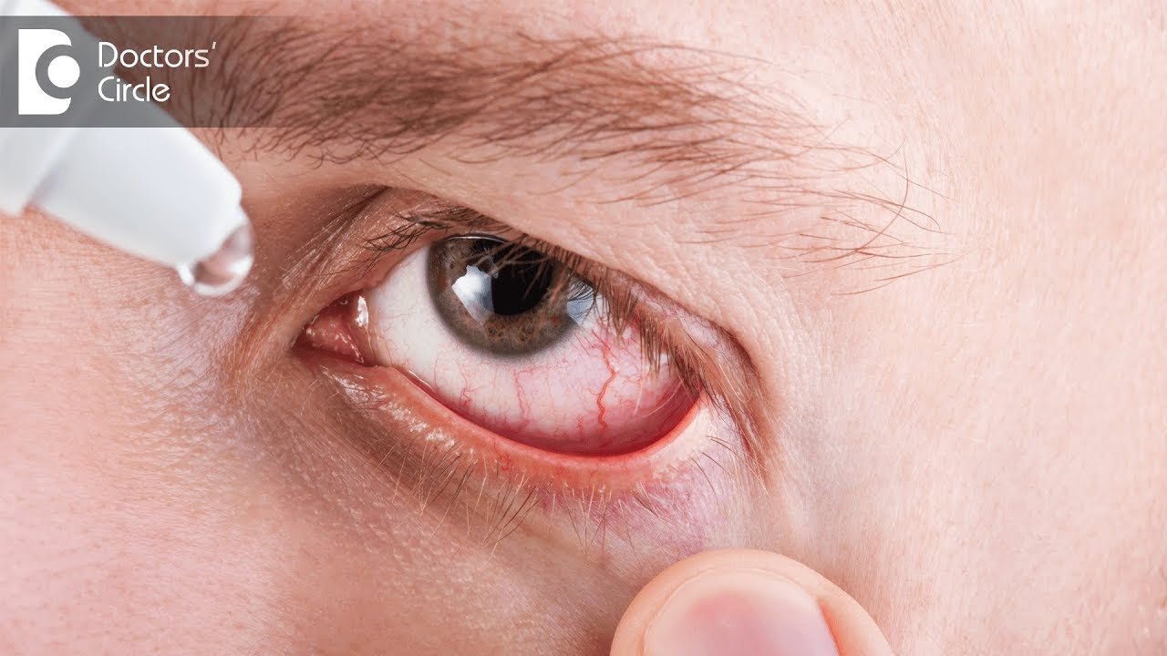 How to treat dry eyes in computer professionals? - Dr. Anupama Kumar