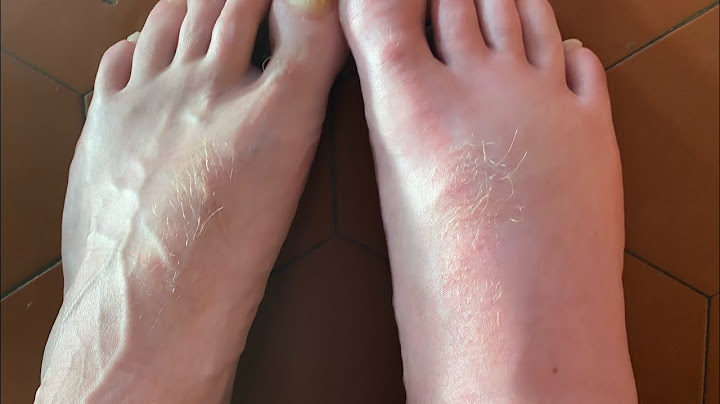 Destruction d’un nid de frelons en grande hauteur très agressif bilan une piqûre aux pieds￼