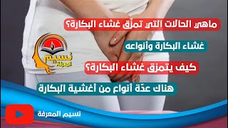 ماهي الحالات التي تمزّق غشاء #البكارة؟  كيف يتمزق غشاء البكارة؟ غشاء #البكارة وأنواعه