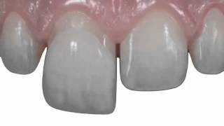 Ronaldo Hirata TIPS 14 Odontologia Estética (Esthetic Dentistry): dica de cimentação