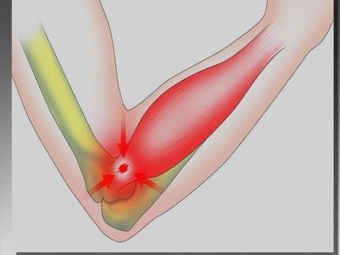 Video: Antigravitet: En Armbåge är Nära, Men Du Biter Inte - Alternativ Vy
