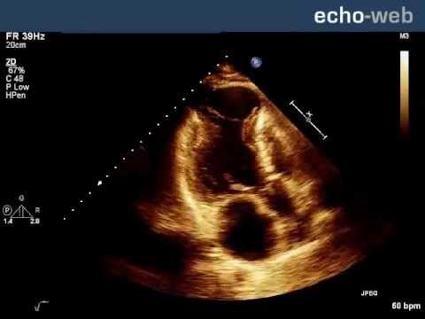 Echo-Web: Left Ventricular Aneurysm - YouTube