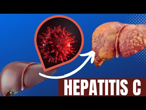 Vídeo: La Hepatitis C Mata A Más Estadounidenses Que Cualquier Otra Enfermedad Infecciosa