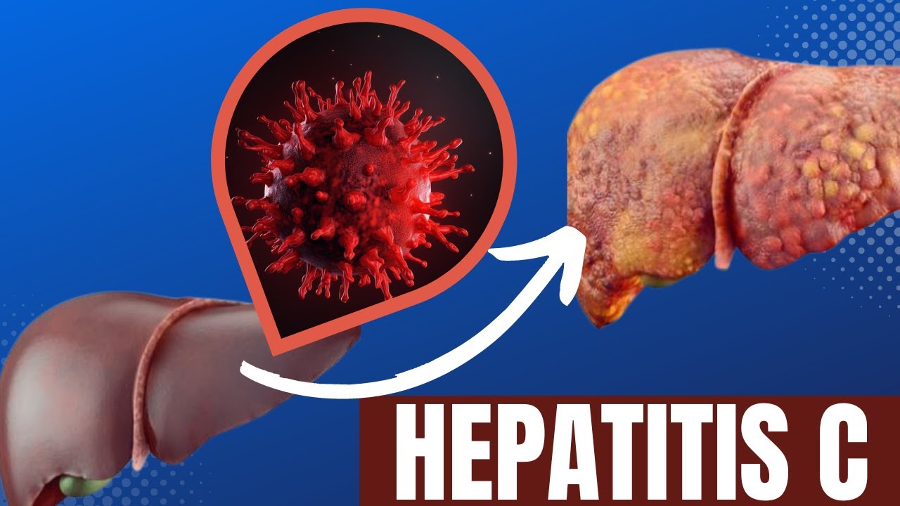 Hepatitis C And C C