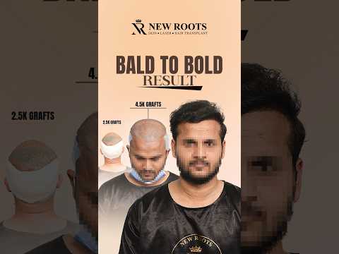 Hair Transplant in Hyderabad | 6 Months Results #hairtransplant #hyderabad #shorts