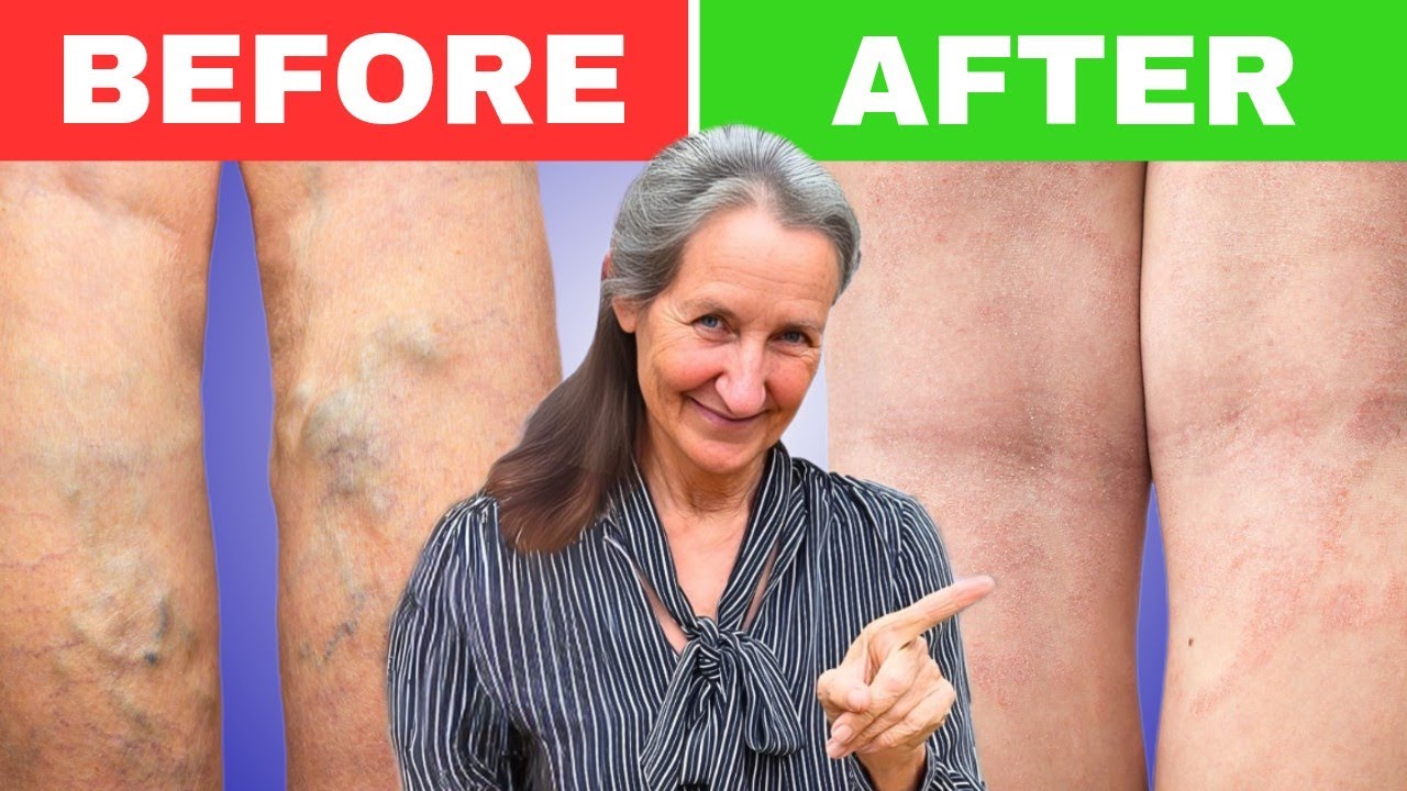Natural Remedies To Eliminate Varicose Veins in the Legs That Doctors Hide | Barbara O'Neill