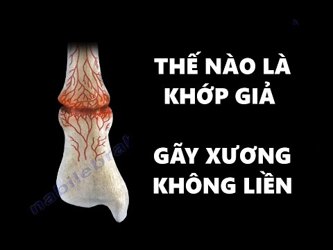 Video KHỚP GIẢ - GÃY XƯƠNG KHÔNG LIỀN - CÁCH XỬ LÝ - youtube