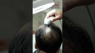 Considering a Hair Transplant? Start with an Assessment | Dr. Mufassar Nishat Rana