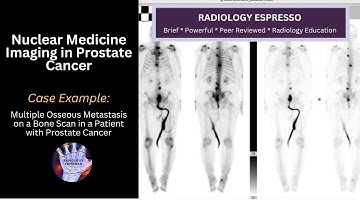 NUCLEAR MEDICINE IMAGING IN PROSTATE CANCER: Case Example –Multiple Osseous Metastasis on Bone Scan