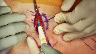 prostate biopsy video