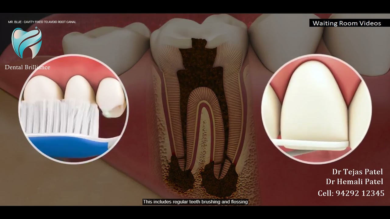Endodontics - Cavity Fixed To Avoid Root Canal