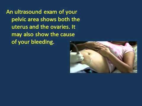 abnormal-uterine-bleeding