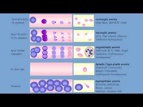 A teaching video for medical students that emphasizes recognizing the red cell production anemias and their causes.