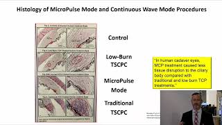 MicroPulse TLT: Improving Outcomes and Patient Experience - Michael C. Giovingo, MD