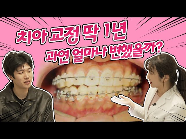 딱 1년 치아 교정 과정 결과! 처음과 1년 후, 얼마나 달라졌을까? #치아교정 #교정치료과정 #교정과정 I 스마일뷰치과 러블리 김원장