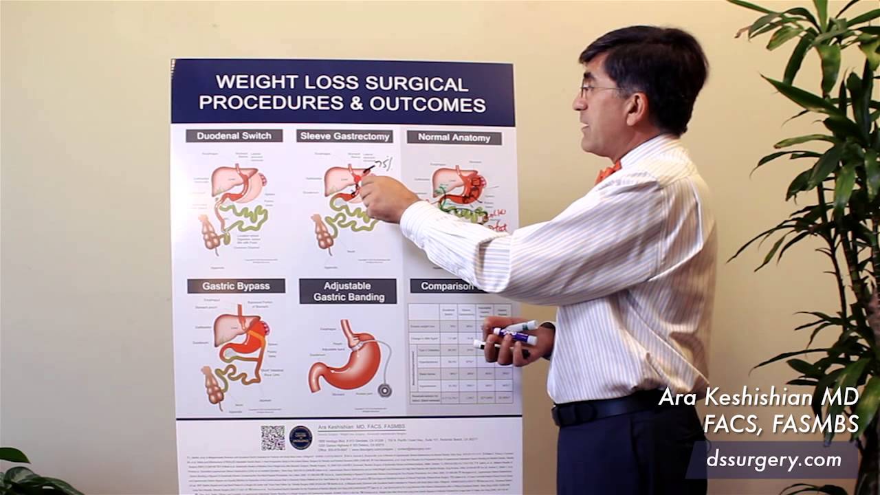 Weight Loss Surgical Procedures Part 2 YouTube