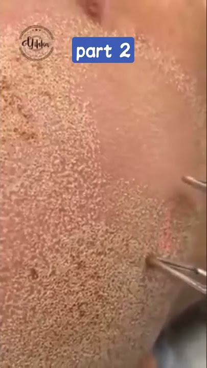 laser pengencang kulit wajah #laser #viral