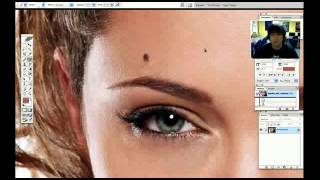 Mole removal Warts and skin tags away Removal Without Surgery