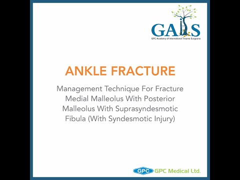 Ankle Fracture -