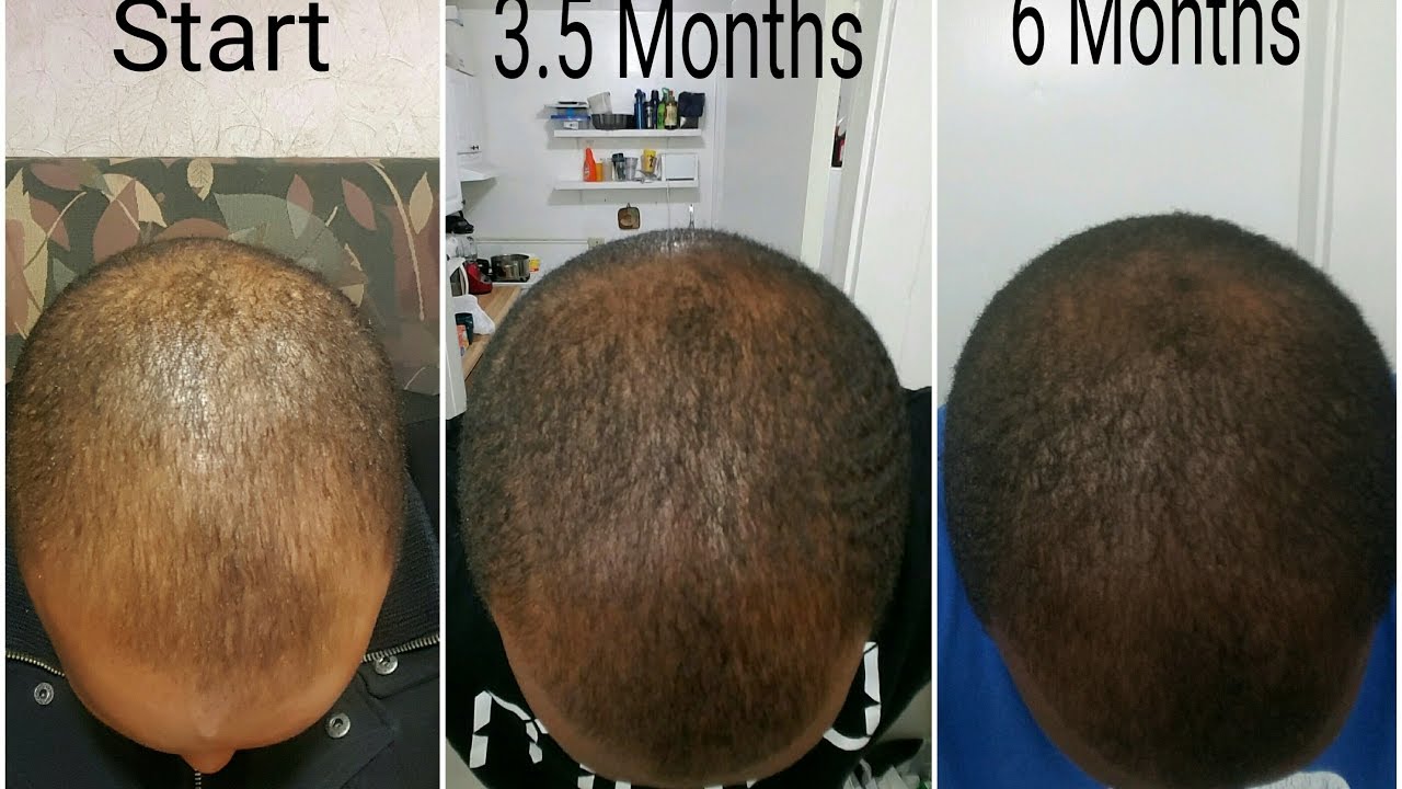 How To Regrow Thinning Alopecia Edges Bald Spots And Receding