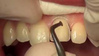 Das perfekte Veneer - Dr. Verbeck und die Dental Alliance
