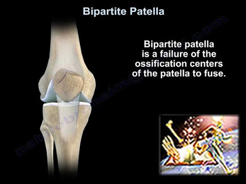 Video: Bipartit-patella: Symptomer, årsager Og Behandling