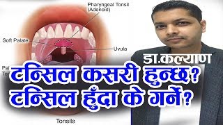 टन्सिलको कसरी हुन्छ? टन्सिल हुँदा के गर्ने? डा.कल्याण||DR. Kalyan |Tonsil||