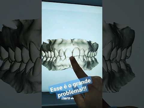 invisalign simulação #invisalign
