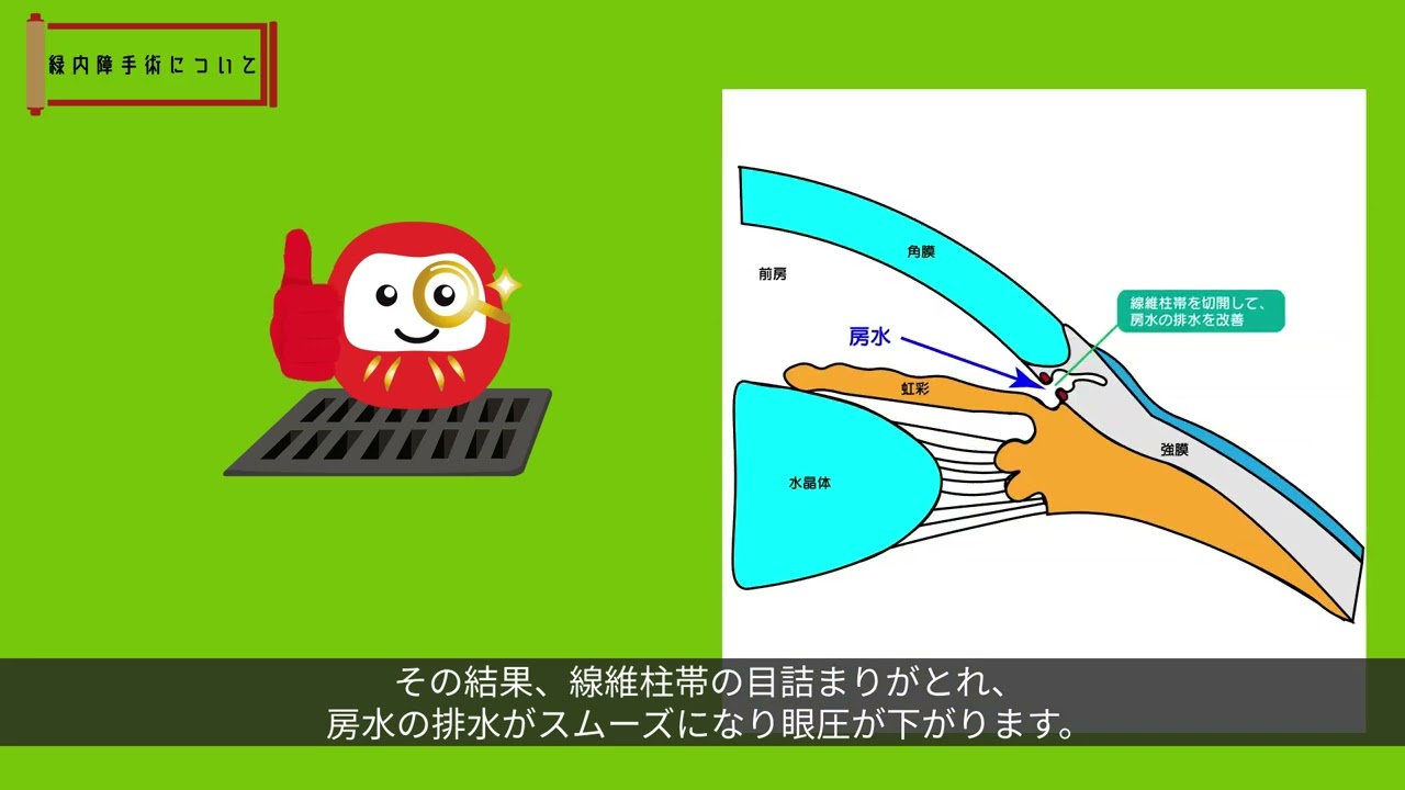緑内障手術 WEB動画付き　裁断済み 白内障緑内障同時手術（線維柱帯切開術（眼外法））の説明 - YouTube