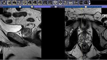 How to read a Prostate MRI