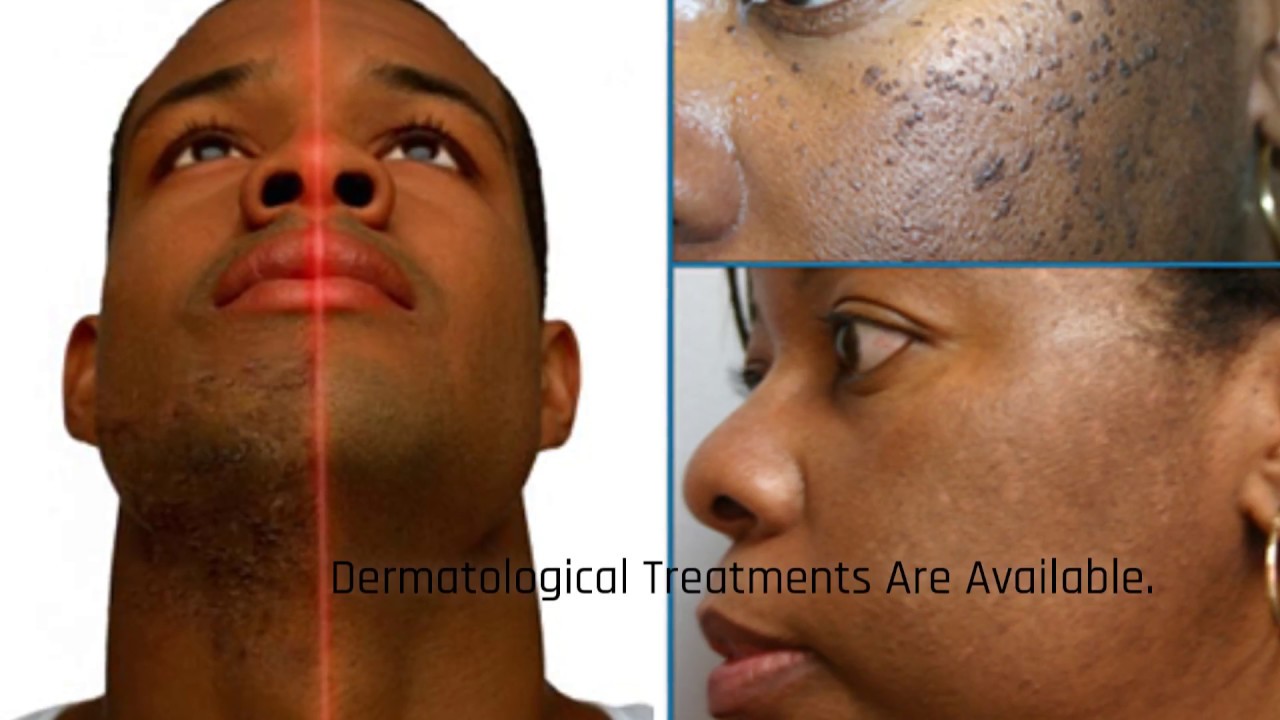 Darker Skin Conditions: Keloids | Advanced Dermatology Assoc. | (212) 262-2500