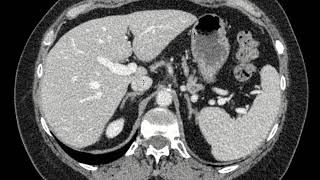 Bosniak 2 renal cyst on CT