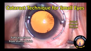 Complete Case: Cataract Surgery in a Small Eye - What is different?