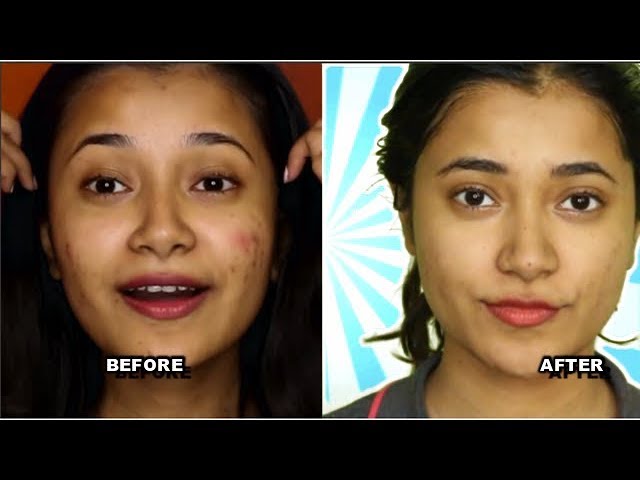 How I cleared my acne || My acne Journey